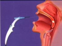 腺样体肥大的四大危害